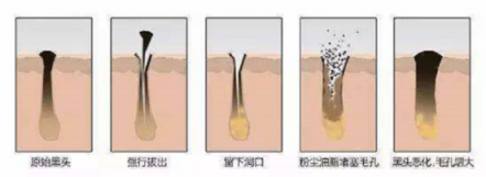 XNUO心諾黑頭儀，用科學的方法祛除黑頭