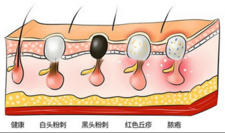 讓黑頭乖乖跑出來，黑頭儀有用嗎？