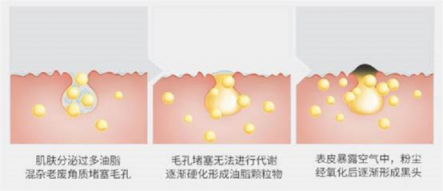 擺脫黑頭困擾，黑頭儀有用嗎？