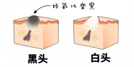 黑頭儀有用嗎？實力派去黑頭就選它！