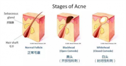黑頭儀有用嗎？用了它終于擺脫了頑固黑頭！