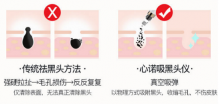 黑頭儀有用嗎？用了它終于擺脫了頑固黑頭！