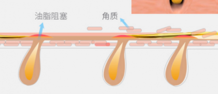 一百種去黑頭的方法都失敗了？去黑頭攻略全部拿下！