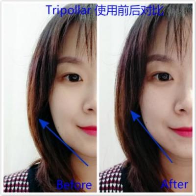 雅萌、GEVILAN歌嵐、Tripollar、NEWA美容儀到底選哪個(gè)？先評(píng)測一下再說