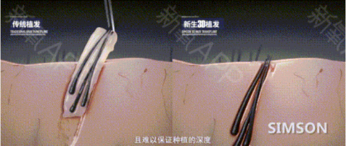 疫情下有人賺百萬，有人瀕臨倒閉，3D植發(fā)技術(shù)在行業(yè)中成“異類”
