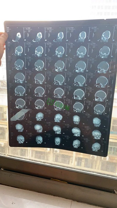 湖南婁底6歲女童遭男子揮鋤頭砸傷，輕松籌上已籌集百萬(wàn)愛(ài)心善款
