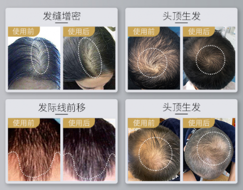 小米眾籌銷量驚人的可思美激光生發(fā)帽，真的能生發(fā)嗎？