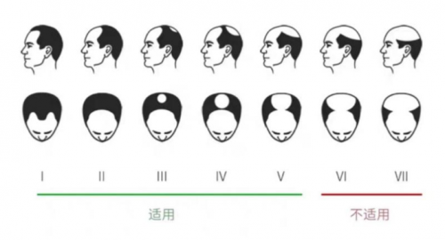 小米眾籌銷量驚人的可思美激光生發(fā)帽，真的能生發(fā)嗎？