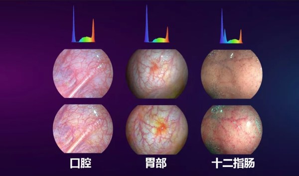 光隨影動 開立醫(yī)療國產(chǎn)內(nèi)鏡功能領(lǐng)跑智能新方向