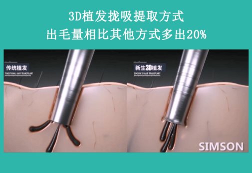 雙12熬夜搶防脫產(chǎn)品？重慶新生植發(fā)：植養(yǎng)護(hù)搭配更靠譜
