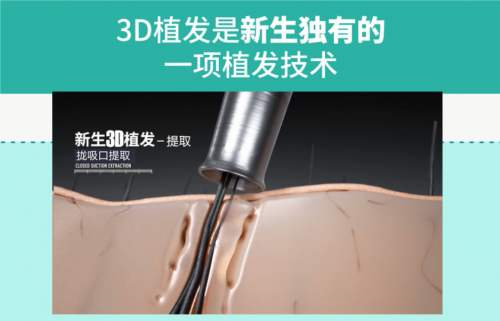 選對植發(fā)機(jī)構(gòu)多重要？杭州新生3D植發(fā)二次修復(fù)助力發(fā)友煥新顏