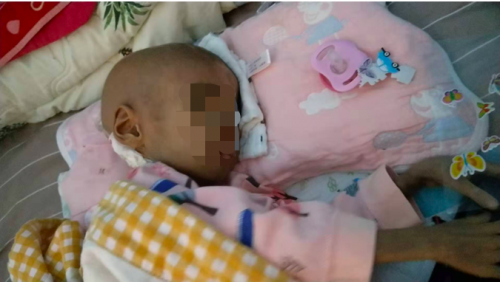 4歲女童得罕見病只有11斤，高昂費用壓垮母親，水滴愛心接力帶來希望