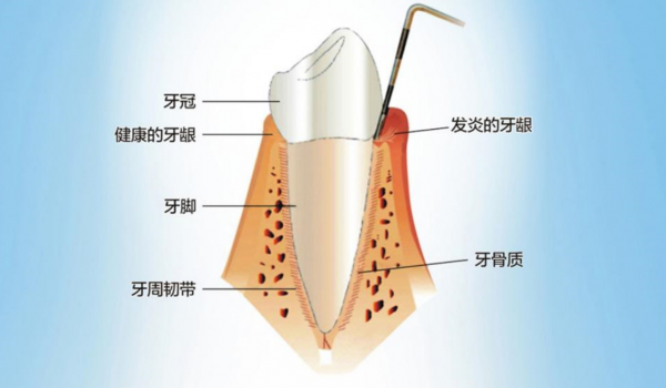 牙縫變大、總?cè)?，警惕“牙周病?/></p><p><strong>牙周病發(fā)病隱匿，早期一般無癥狀</strong></p><p>李永劍院長介紹，牙周病是指發(fā)生在牙周組織的疾病，包括牙齦組織的牙齦病和波及深層牙周組織(牙周膜、牙槽骨、牙骨質(zhì))的牙周炎兩大類。牙周疾病是常見的口腔疾病，也是引起成年人牙齒喪失的首要原因。</p><p>“牙周病與齲齒不同，它起病隱匿，初期不會(huì)疼痛，早期僅有出血等輕微癥狀，且病程長，可達(dá)數(shù)年之久，因此很容易被忽視。” 李永劍院長表示，牙周病的早期癥狀是刷牙和咬硬物出血，如果在這個(gè)階段進(jìn)行積極治療，效果好，花費(fèi)少。如果等到出現(xiàn)疼痛、腫脹、牙齒松動(dòng)、脫落或咀嚼功能障礙時(shí)，已錯(cuò)過最佳治療時(shí)機(jī)，不僅治療難度加大，治療費(fèi)用增加，而且無法恢復(fù)到原來的健康水平。</p><p align=