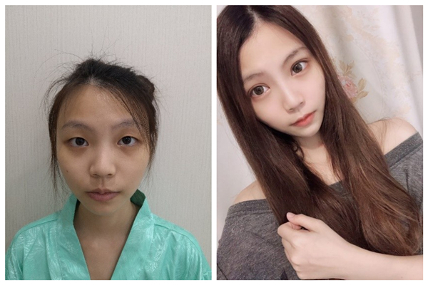 佛山美萊張春光主任赴“大開眼界”全國眼整形及面部年輕化美容峰會，眼部專家齊聚交流探討尖端技術(shù)
