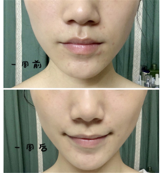 抗糖化能祛痘？HFP肌肽原液開箱使用一周真實效果測評