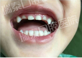 瑞泰口腔醫(yī)院兒童全麻舒適治療，讓寶寶看牙不再恐懼